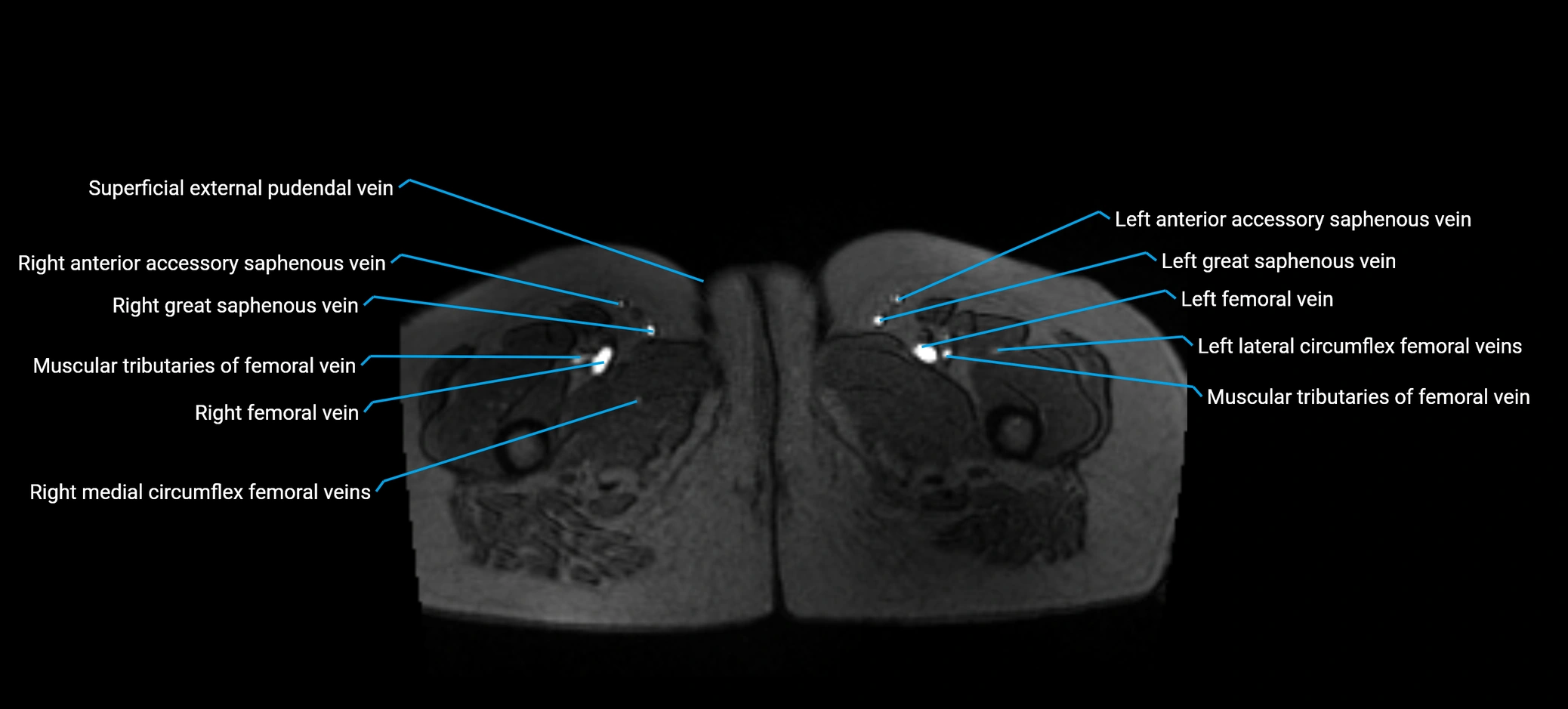 MRV abdomen pelvis & lower limb axial cross sectional anatomy labelled MRI image 211 (1).webp